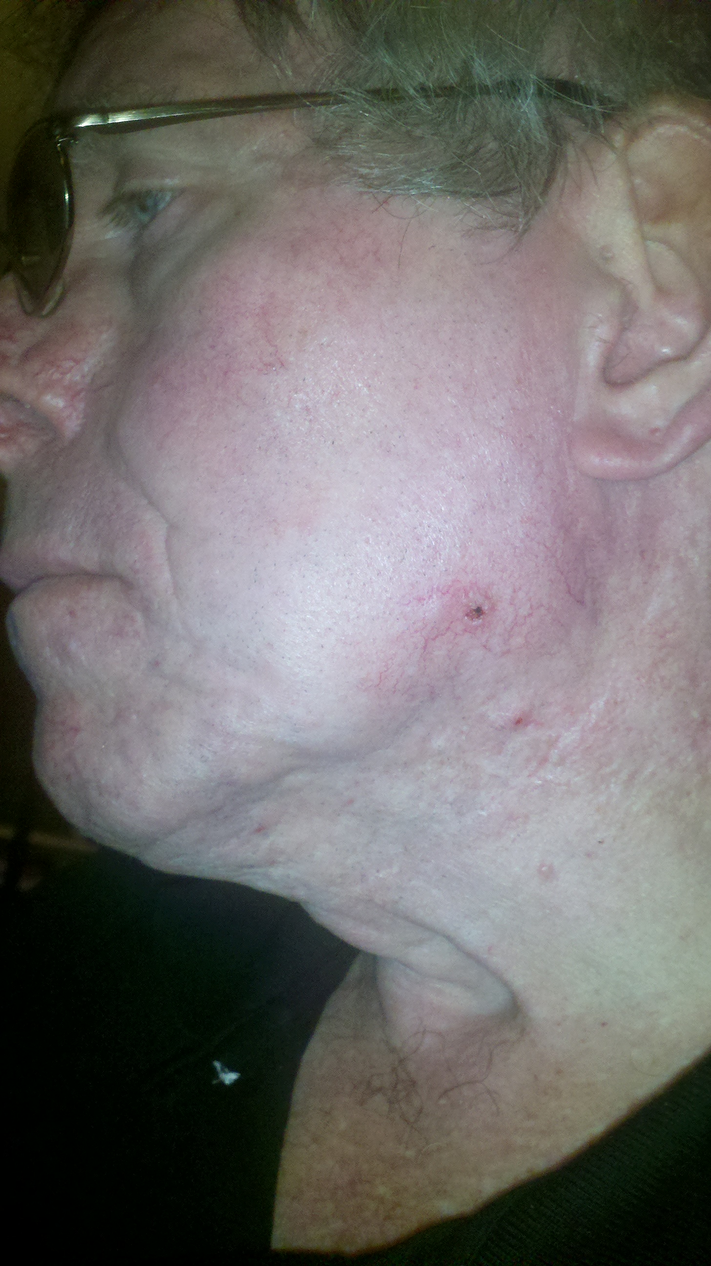 Photo of the lesion, Nov. 15